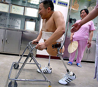 Bionic limbs enable legless man to walk again